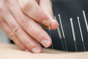 Functional Dry Needling - Acupuncture - Grove Chiropractic